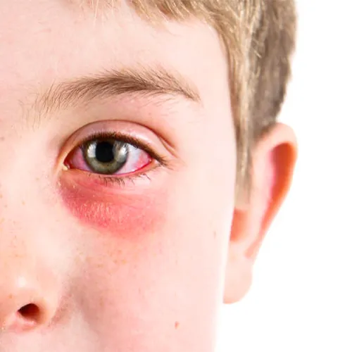 احساس وجود جسم خارجی در چشم در نتیجه بیماری التهاب ملتحمه-کونژنکتیویت